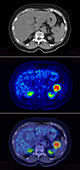 Pancreatic cancer, CT and PET scan