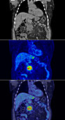 Pancreatic cancer, CT and PET scan