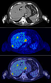 Secondary liver cancer, CT and PET scan