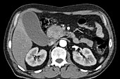 Pancreatic cancer, CT scan