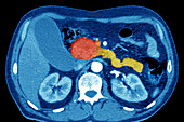 Pancreatic cancer, coloured CT scan