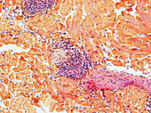 Skin lymphocytes in secondary syphilis, light micrograph
