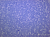 Burkitt's lymphoma, light micrograph