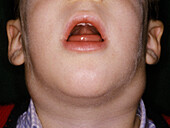 Infectious mononucleosis