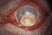 Corneal abscess