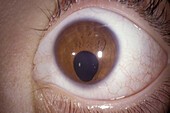 Coloboma of the eye