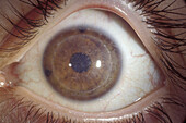 Corneal dystrophy recurrence on graft