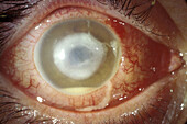 Corneal abscess and hypopyon