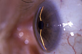 Cornea and iris, slit lamp examination