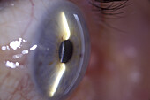 Cornea and iris, slit lamp examination