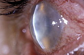 Corneal ulcer and abscess