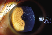 Adenovirus keratitis