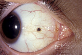 Conjunctival naevus