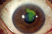 Herpetic corneal ulcer
