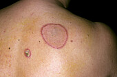 Lesions in fixed drug eruption