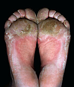 Congenital ichthyosiform erythroderma