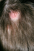 Folliculitis decalvans