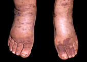 Endemic Kaposiâ€™s sarcoma