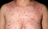 Pityriasis rosea rash