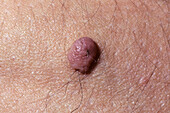 Pedunculated mole