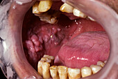 Oral florid papillomatosis
