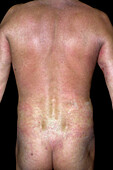 Parapsoriasis lichenoides skin lesions