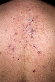 Prurigo lesions on a man's back