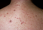 Prurigo nodularis lesions