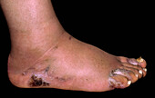 Kaposi's sarcoma on foot of AIDS patient