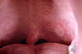 Syphilis ulcer in mouth