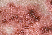 Shingles rash