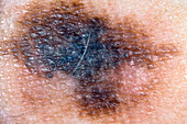 Superficial spreading melanoma