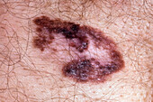 Lentigo maligna melanoma