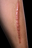 Hypertrophic scarring