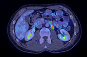 Secondary lymph node cancer, combined CT and PET scans