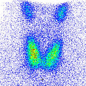 Thyroid gland, scintigram