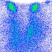 Thyroiditis, scintigram