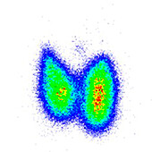 Graves' disease, scintigram