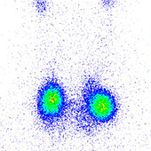 Toxic thyroid adenomas, scintigram