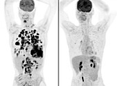 Secondary cancer before and after treatment, PET scan