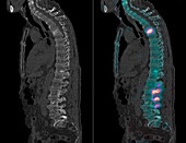 Secondary bone cancer of the spine, scintigram and CT scans