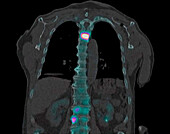 Secondary spinal cancer, composite scintigram and CT scan