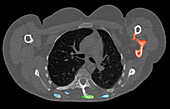 Fibrodysplasia ossificans progressiva, CT scan