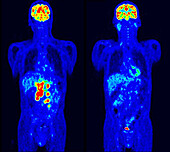 Diffuse large B-cell lymphoma, PET scans