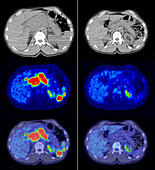 Diffuse large B-cell lymphoma, CT and PET scans