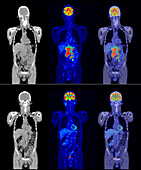 Diffuse large B-cell lymphoma, CT and PET scan