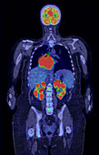 Diffuse large B-cell lymphoma, composite CT and PET scan
