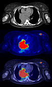 Diffuse large B-cell lymphoma, CT and PET scans