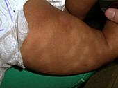 Pityriasis alba