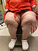 Lymphoedema